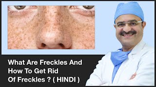 What Are Freckles And How To Get Rid Of Freckles  ClearSkin Pune  In HINDI [upl. by Ajam870]