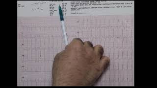 Left Posterior fascicular VT [upl. by Anetsirk]