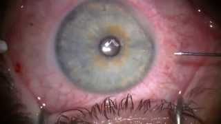 Lasik flap [upl. by Faden]