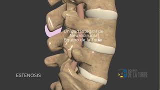 Estenosis 3D  Unidad Integral de Neurocirugía Equipo de la Torre [upl. by Goldenberg276]