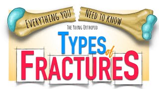 Bone Fracture Types amp Mechanisms  ANIMATION  Fracture classification  The Young Orthopod NEET PG [upl. by Alabaster178]