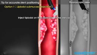 Hanaro Oesophageal Stents Demonstration Video [upl. by Dominik]