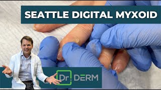 Digital Myxoid from Seattle  Dr Derm [upl. by Sibylle81]