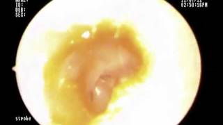 Total Ear Drum Perforation [upl. by Emirak]