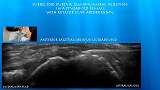 Ultrasound Guided Subdeltoid Bursa Glenohumeral injection in a Female with Rotator Cuff Arthropathy [upl. by Minica]