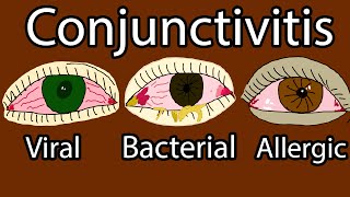 Pink Eye Conjunctivitis  Viral Bacterial and allergic conjunctivitis Symptoms and treatment [upl. by Delainey]