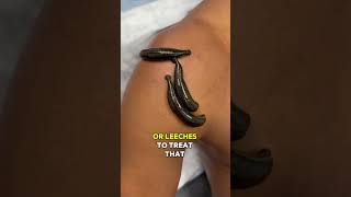 Leech Therapy for Shoulder Pain [upl. by Cotter]