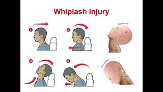 lecture 3 completion atlantoaxial  atlantooccipital joints   Hyoid bone [upl. by Alakam]