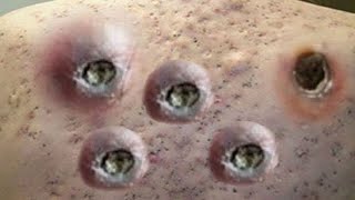 إضاءة أضواء الليل ليلاً 7006 Acne Removal l Acne Extraction  Blackheads Removal Extraction [upl. by Aedni]