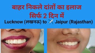 बाहर निकले दांतों का इलाज सिर्फ 2 दिन में  Lucknow to jaipur rajasthan smile makeover smile [upl. by Unam]