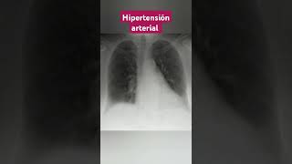 HIPERTENSION ARTERIAL MAGNIFICACIÓN DE LA SILUETA CARDIACA [upl. by Rednaeel]