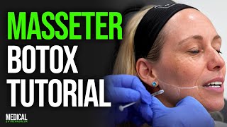 Masseter Botox for Facial Slimming and Migraines  Full Procedure Demonstration [upl. by Ajnot]