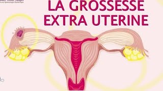 GYNECOLOGIE Grossesse extrautérine  les signes à connaître et la conduite à tenir [upl. by Ineslta]