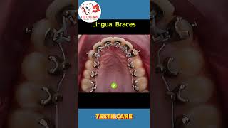 braces transformation teeth braces dental dentalcare dentalhealth dentalimplants shorts [upl. by Einnim829]