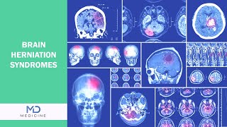 Brain Herniation syndromes Types Symptoms and Treatment [upl. by Vincenta]