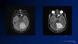 Neuroradiology board review 3 case 8 [upl. by Nahoj]