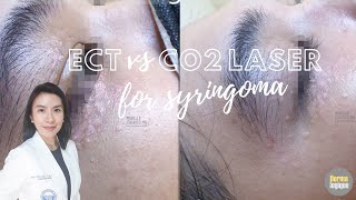 Syringoma Removal Electrocautery vs CO2 Laser [upl. by Adnahcir]