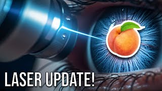 LASER Surgery Update  Hemorrhoids Anal Fistula Pilonidal Cyst [upl. by Horwath]