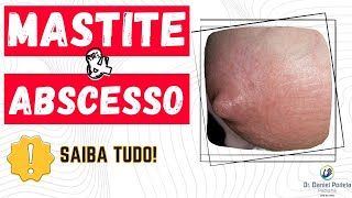 Mastite e abscesso mamário o que são [upl. by May]