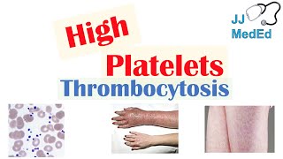 What Causes High Platelets Thrombocytosis  Approach to Causes Symptoms Treatment [upl. by Amilah]