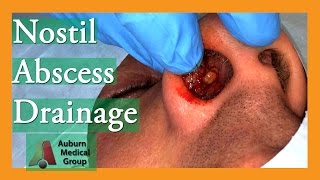 Nostril Abscess Drainage  Auburn Medical Group [upl. by Imojean]