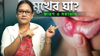 মুখের ঘা অবহেলা করবেন না Aphthous Ulcer Explained [upl. by Iverson]