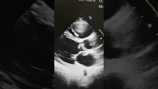 Case9 Echocardiography Aortic valve vegetation with aortic root absecce [upl. by Repotsirhc535]