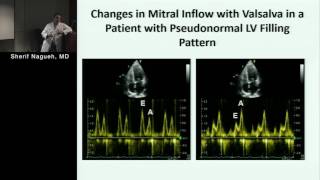 Multicenter Study of Echocardiographic Assessment of LV Filling Pressures [upl. by Esilrahc]