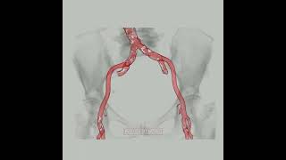 Iliofemoral arteries for TAVR access [upl. by Charleen]