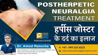 Postherpetic Neuralgia PHN Treatment  हर्पीस जोस्टर के दर्द का इलाज।by Dr Amod Manocha [upl. by Anpas]