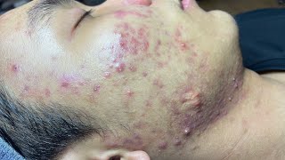 ACNE TREATMENT VU QUYNH MI Blackheads On Boy Face 2024 [upl. by Nnadroj]