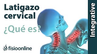 Latigazo cervical  ¿Qué es y cuáles son las claves de su solución [upl. by Basset]