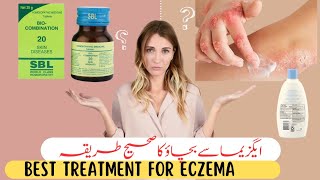 Eczema TreatmentHere is Homeopathic Solutions That Work [upl. by Gaiser]