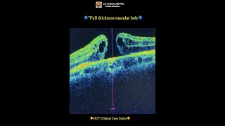 Gass macular hole stages Full thickness macular hole [upl. by Aicittel582]