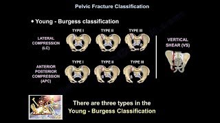 Pelvic Fractures  Everything You Need To Know  Dr Nabil Ebraheim [upl. by Thilda]