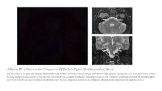 Vestibular Paroxysmia or 8th Nerve Microvascular Compression Syndrome [upl. by Connell]