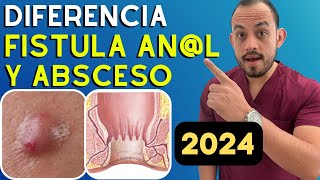 🚩 Absceso y Fistula anorrectal Diferencias Diagnostico y Tratamiento Resumido 2024 [upl. by Nirahs153]