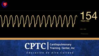 Taquicardia Ventricular [upl. by Yruama]