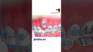 How to Treat Impacted Canines Surgical Exposure amp Orthodontic orthodontistcanineimpactionbrace [upl. by Peregrine]