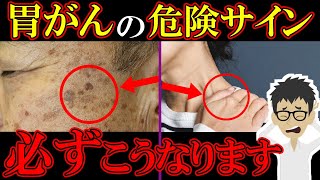 放置厳禁！胃がんの危険な症状5選！○○な人リスク6倍・・・【胃癌｜ガン｜悪性新生物｜胃潰瘍｜原因】 [upl. by Aicened847]