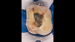 Maxillary Molar Access Opening [upl. by Oilalue]