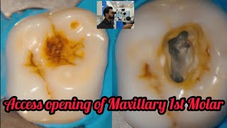 Access opening of Maxillary 1st Molarstep by step rootcanal treatment [upl. by Danas464]