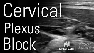 Cervical Plexus Block [upl. by Artina857]