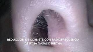 Radiofrecuencia de cornetes [upl. by Wit]