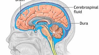 Hydrocephalus  Myelomeningocele  CNS Disorders [upl. by Lorollas]