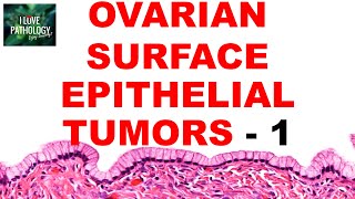 OVARIAN TUMORS  Part 2  SEROUS AND MUCINOUS TUMORS Etiopathogenesis and morphology [upl. by Enaillil213]