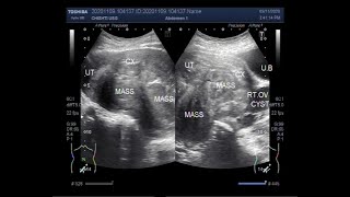 Ultrasound Video showing two large masses in cul de sac [upl. by Alleinnad]