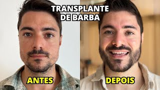 TRANSPLANTE CAPILAR DE BARBA  Todos os Detalhes e Preços [upl. by Eserrehs]