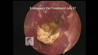 ear wax removal 20230727 [upl. by Hanahsuar]