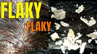 BIG FLAKES  Scalp Psoriasis Removal [upl. by Elleinahc]